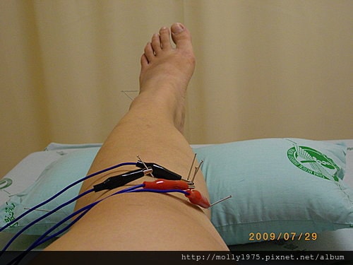 2009年7月-針灸電針